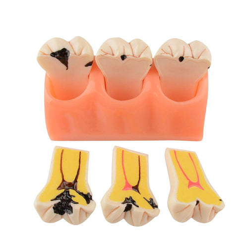 Dental Caries Teeth Model 4 Times Dental Tooth Decay