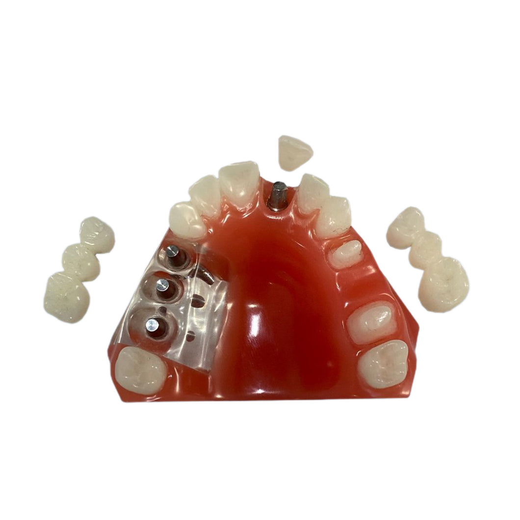 #75-BR 3 unit bridge on 3 implants vs 3 unit bridge on prepared teeth, plus central on implant.