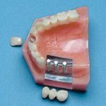 #75-BR 3 unit bridge on 3 implants vs 3 unit bridge on prepared teeth, plus central on implant.