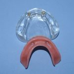 Loc-2 Lower denture w/attachments.